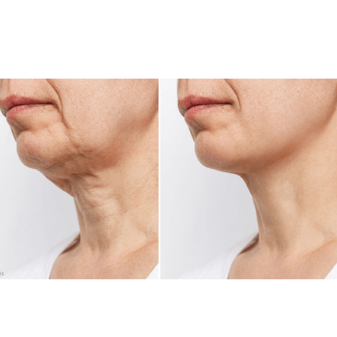 ageing-the-neck-is-clinical